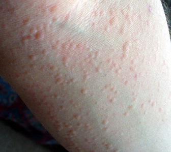 allergia infantile alla polvere