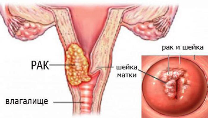 симптоми на рак на шийката на матката