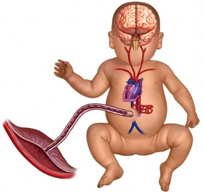 maturazione prematura della placenta