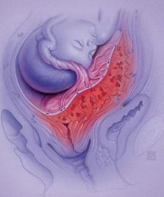 maturazione prematura delle cause della placenta