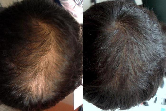 Minoksydyl do włosów przegląda mężczyzn