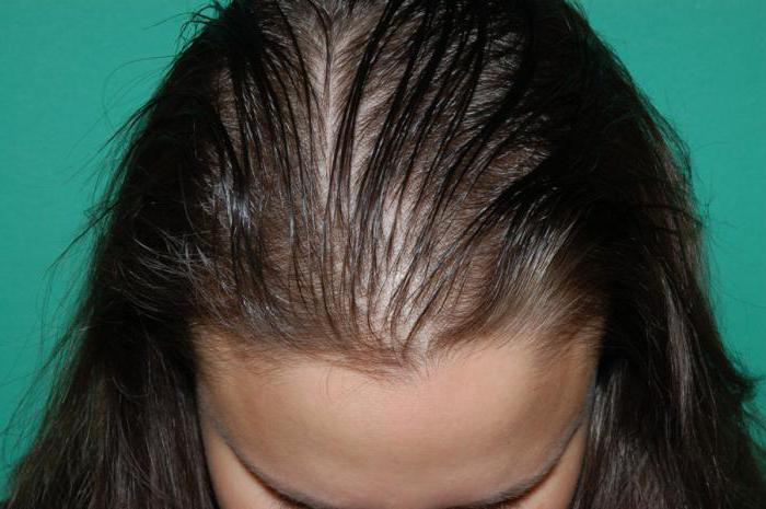 da perdita di capelli minoxidil