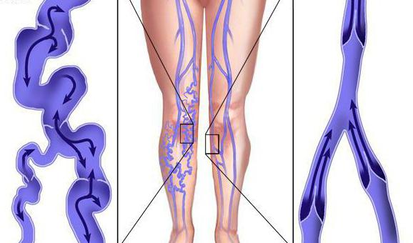 prevenciju proširenih vena u nogama