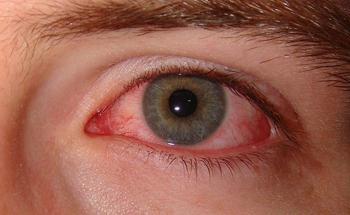 Rdeče kapljice za oči