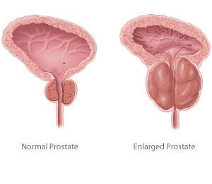 доброкачествена хиперплазия на простатата