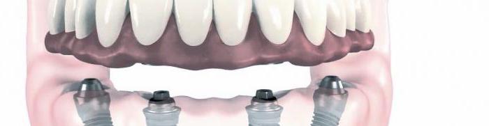 протезиране на зъби