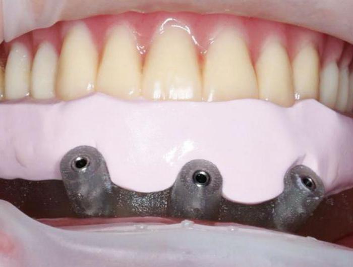 zobne proteze, ki so boljše