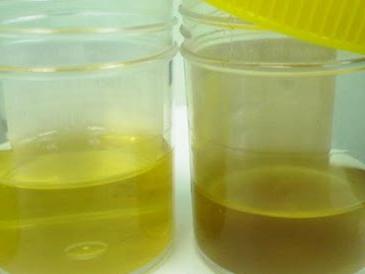 beljakovin v urinu pri otrocih