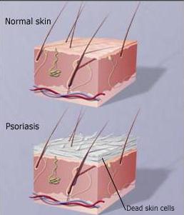 симптоми псоријазе на кожи