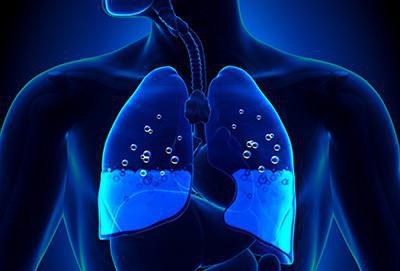 edema polmonare causa di morte