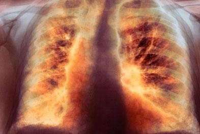 Fibrosi polmonare