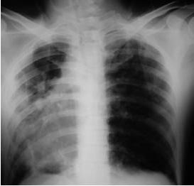 tubercolosi polmonare