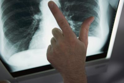 leczenie ludowej gruźlicy płuc
