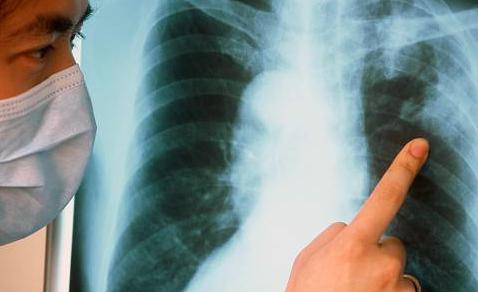 come identificare la tubercolosi polmonare