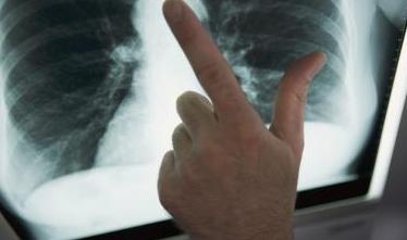 come si manifesta la tubercolosi polmonare