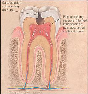příznaky pulpitidy zubu
