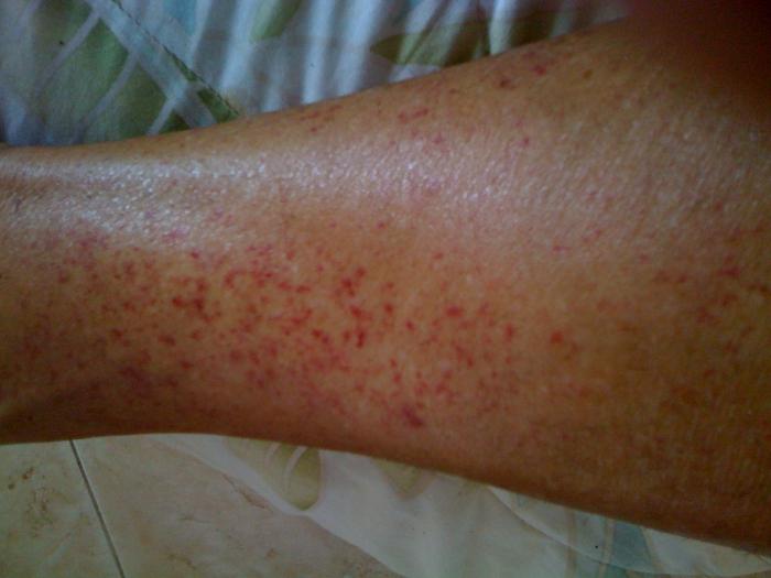 Eruzione cutanea sulle gambe