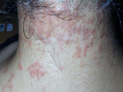 Алергија на осип