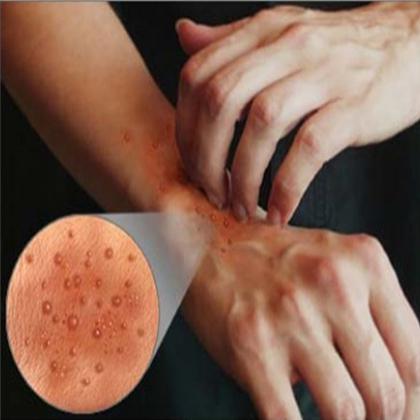 Eruzione cutanea sulla pelle.  trattamento