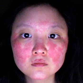 eruzione cutanea rossa sul viso
