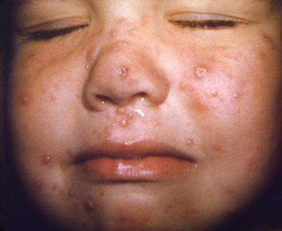 Eruzione sul viso di un bambino