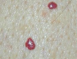 male crvene točkice na tijelu