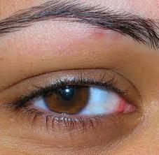 vzrok rdečih oči