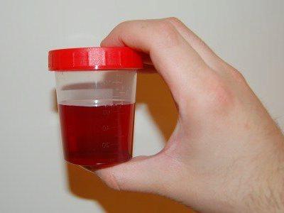 Crveni urin