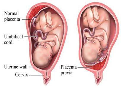 placenta previa 17 týdnů