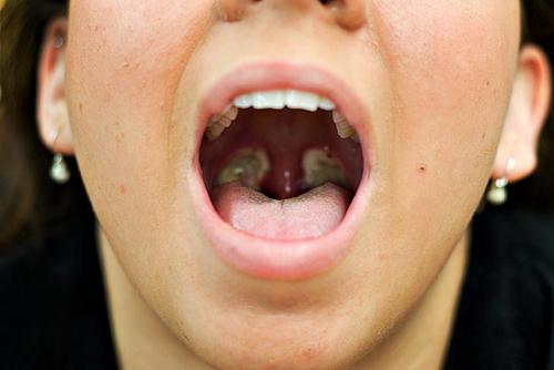 rimozione delle tonsille