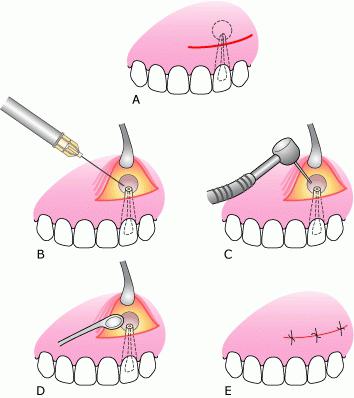 resekcija korijena zuba