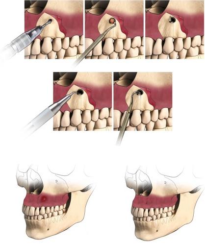 nakon resekcije korijena zuba