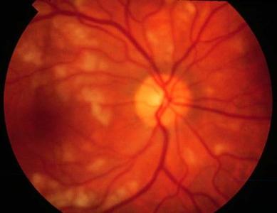 retinalna angiopatija