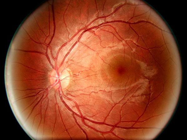 Снимка на отлепване на ретината