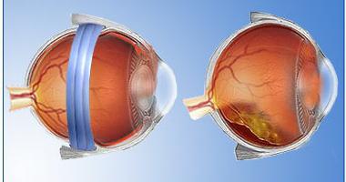 Лечение на отлепване на ретината