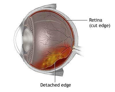 симптоми на отлепване на ретината