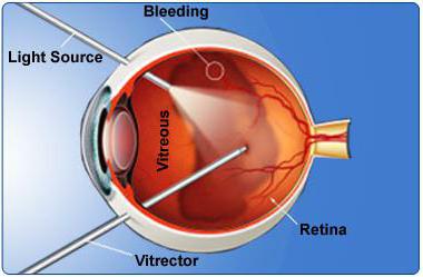 distacco della retina