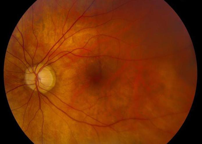 узроци кидања ретине