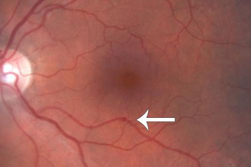 симптоми на разкъсване на ретината