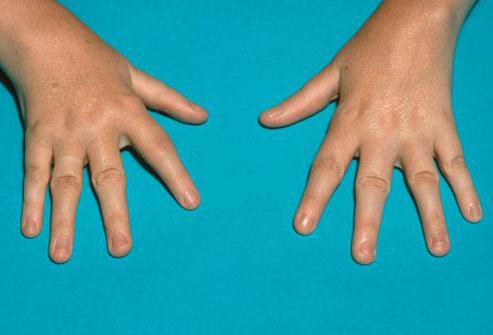 liječenje artritisa prstiju