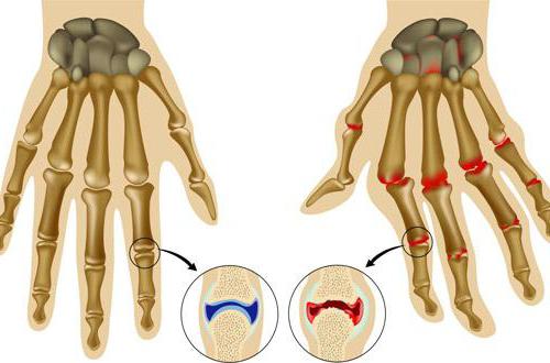 реуматоидни артритис прстију