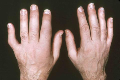 revmatoidní artritida prstů