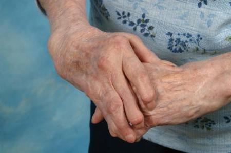 come curare l'artrite reumatoide