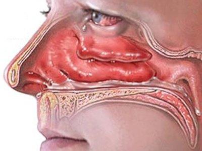 Leczenie ostrego zapalenia błony śluzowej nosa