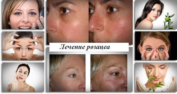 recensioni trattamento viso rosacea