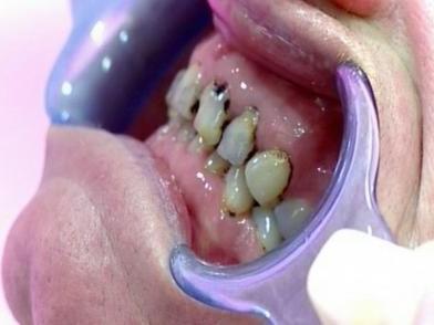 Черни зъби