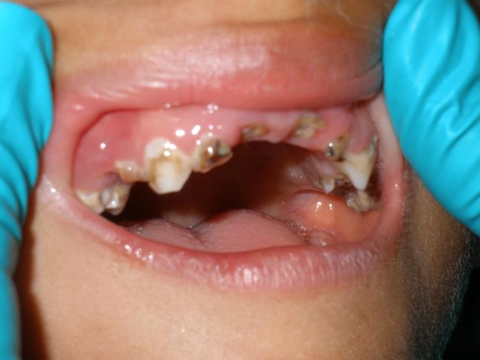 Rotující zub