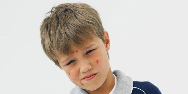 simptomi rubeole kod djece