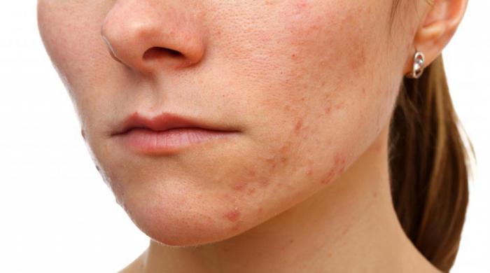 recensioni dell'acne dell'acido salicilico
