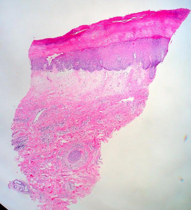 vulvar scleroatrophic lichen